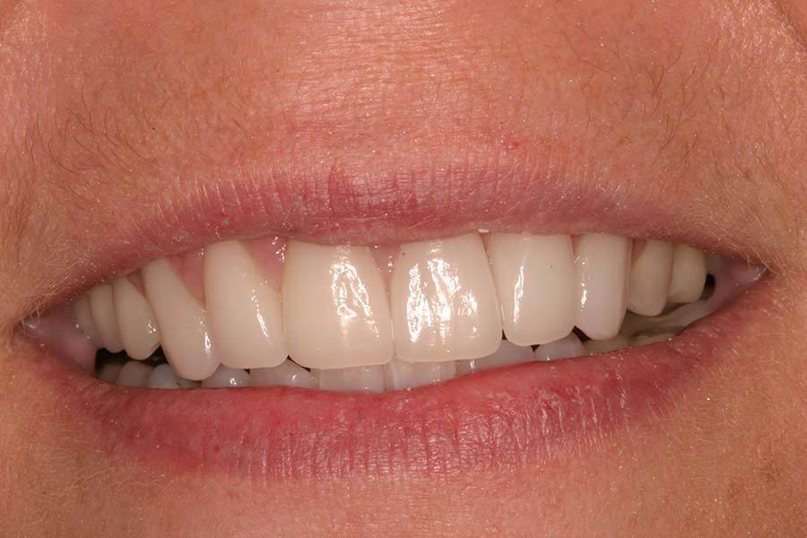 dental-crowns-eastover-dental